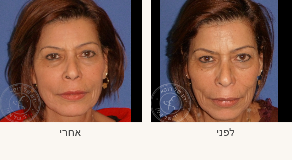 צילום של אישה לפני ואחרי קבלת זריקות שומן עצמיות, המציג את השיפור בנפח הפנים ובקונטור.